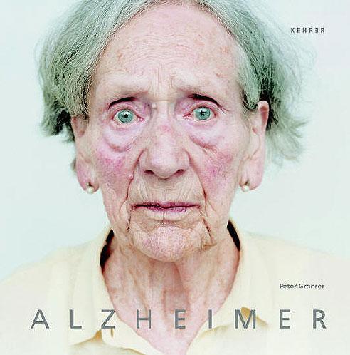 Alzheimer, una enfermedad que puede prevenirse