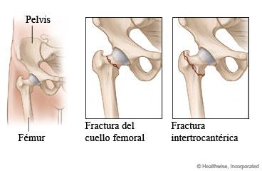 Los tipos de fracturas