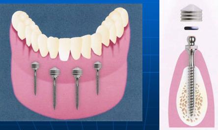 Prótesis dentales fijas amenor costo