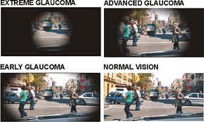 Glaucoma