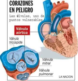 Inician implantes de válvula aórtica por la punta del corazón