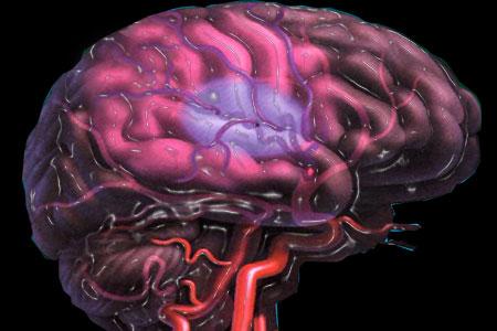 En nuestro país, cada cuatro minutos una persona es víctima de un accidente cerebrovascular