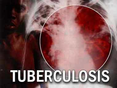 En Argentina se notifican casi 10.000 casos de tuberculosis por año