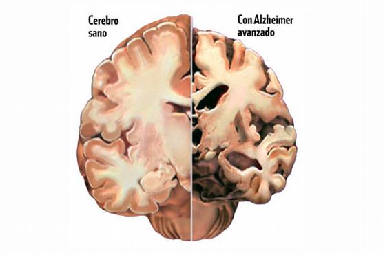 Descifran un mecanismo clave del Alzheimer