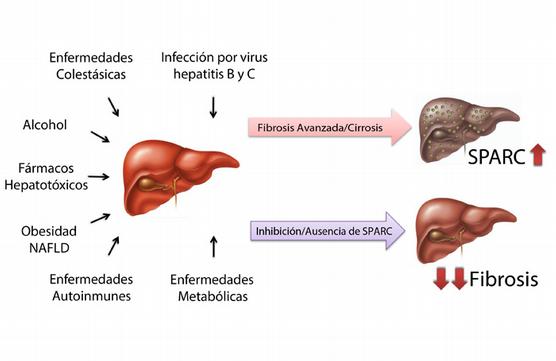 Investigan un tratamiento prometedor para la cirrosis hepática