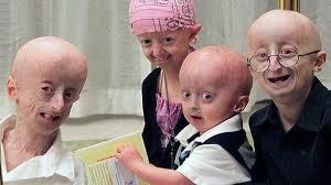 Niños con progeria