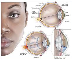 Glaucoma