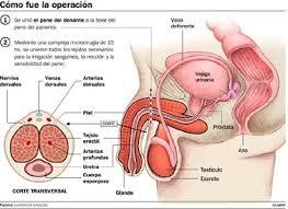 Operación