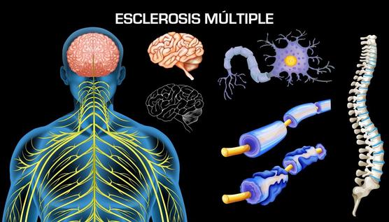 Esclerosis múltiple