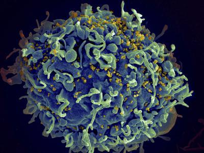 Imagen muestra una célula T humana, de color azul, atacada por el VIH (en amarillo)