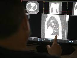 Imagen de una radiografía de pulmones en el marco de un programa de rastreo de cáncer de pulmón afp